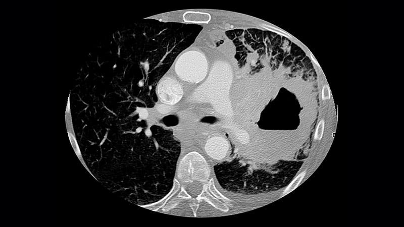 Do Co-Medications Cut Immunotherapy Benefit in Lung Cancer?
