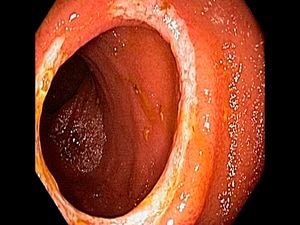 Capsule Endoscopy–Guided Treatment Reduces Flares in Crohn's
