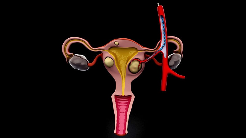 Hysterectomy Avoided With Uterine Embolization After Birth