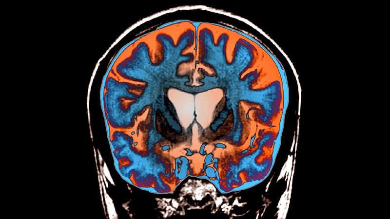 Progressive Motor, Cognitive Decline in 51-Year-Old Woman