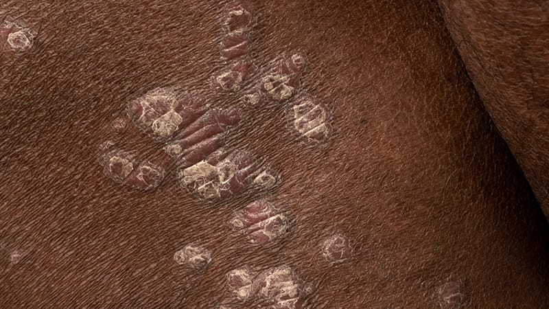 Study Addresses Racial/Ethnic Disparities in Psoriasis Rx - Vimarsana News