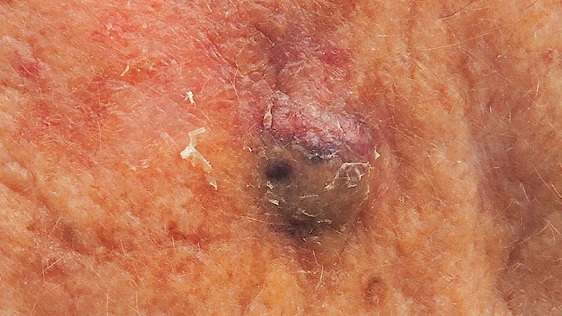 非白人ヒスパニックのメルケル細胞癌を調査する研究