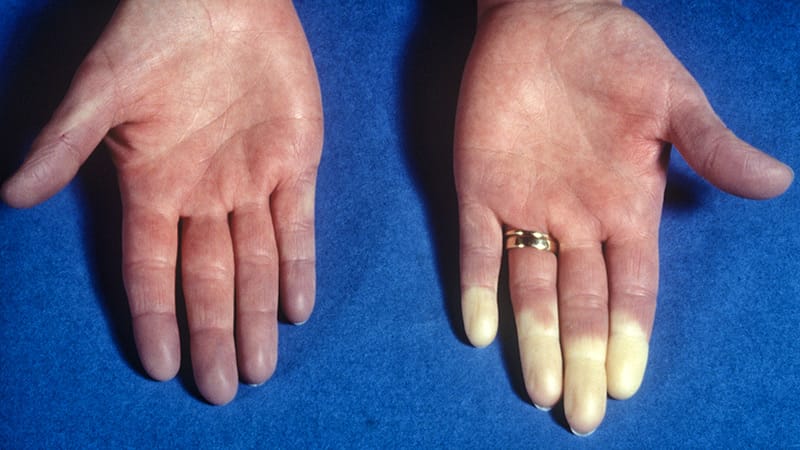 Raynaud Phenomenon Tied to Elevated Cardiovascular Risk