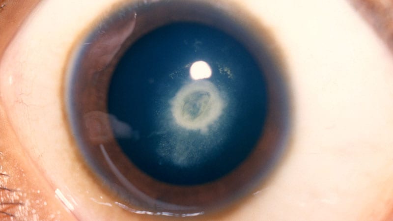 Early Patching Benefits Kids Born With Cataract in One Eye