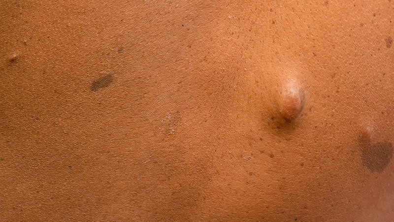 Novel Treatments for Cutaneous Neurofibromas Show Promise