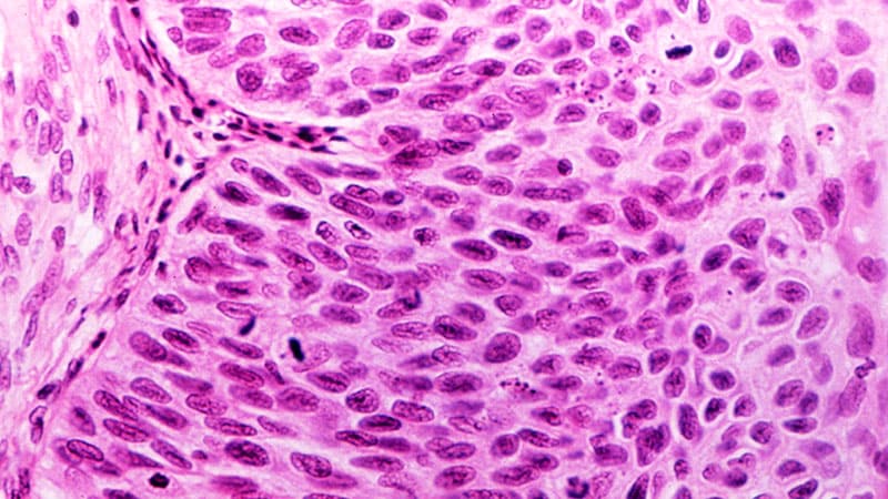 HPV Vaccine ‘Very Promising’ for Nixing Precancerous Lesions