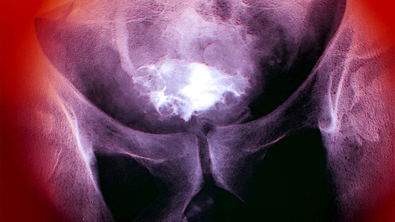 Rapid Review: Bladder Cancer
