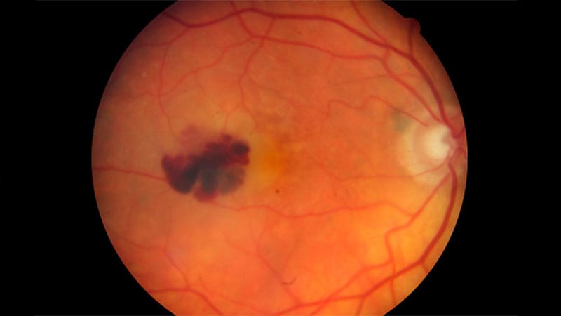Intensive Bevacizumab Boosts Vision in Macular Degeneration