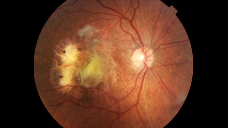 HDL and Eye Disease: A Goldilocks Effect?