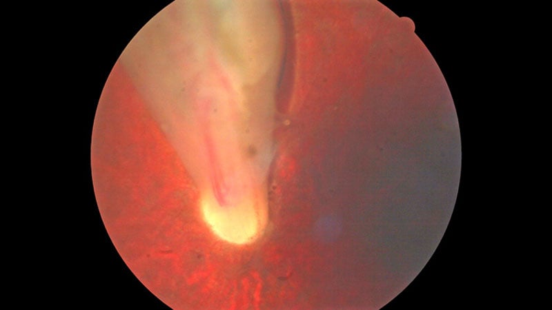 Eyes With IOLs Do Worse With In-Office Retina Repair