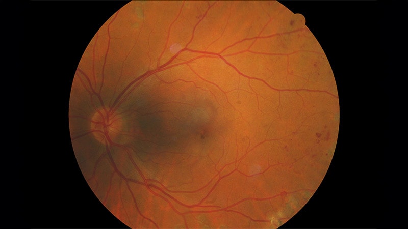 'Stunning' increase in diabetic retinopathy since 2015
