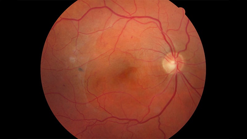 More Anti-VEGF Injections Might Increase Visual Acuity