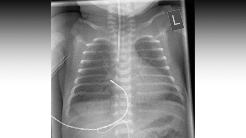 Antenatal Steroids Tied to Lower BPD Risk in Preemies