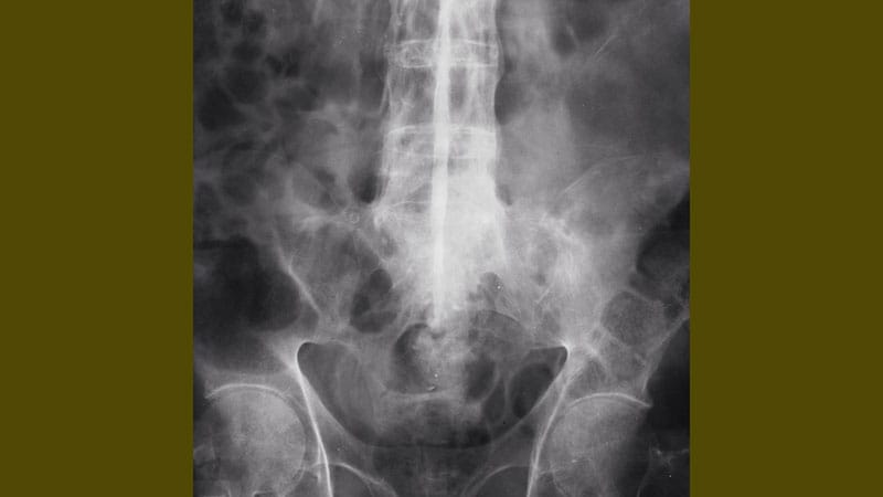 A Woman With Bloody Diarrhea and Abdominal and Joint Pain - Medscape Reference