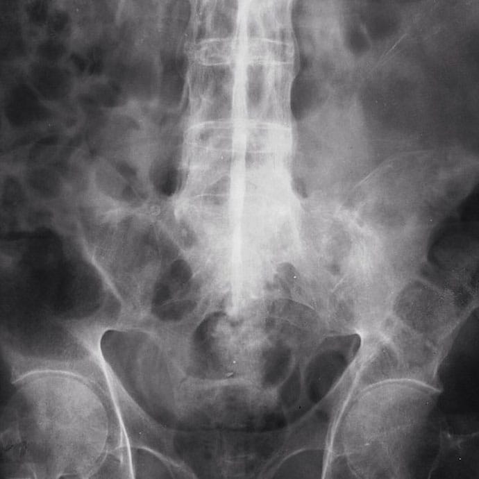 A Woman With Bloody Diarrhea and Abdominal and Joint Pain