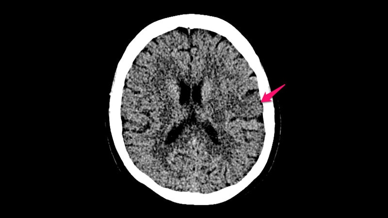 Expanded Window of Stroke Thrombectomy With Simpler Imaging