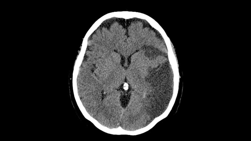 Thrombectomy Less Beneficial in Large-Core Stroke