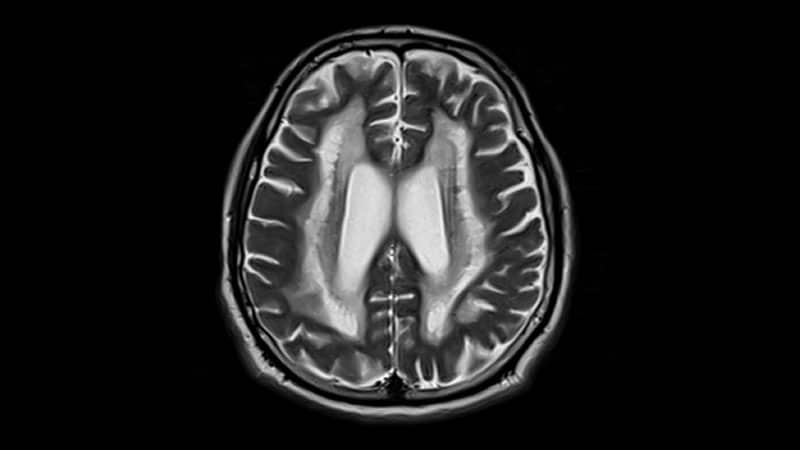 Brain Frailty Mediates Link Between Age and Stroke Outcomes