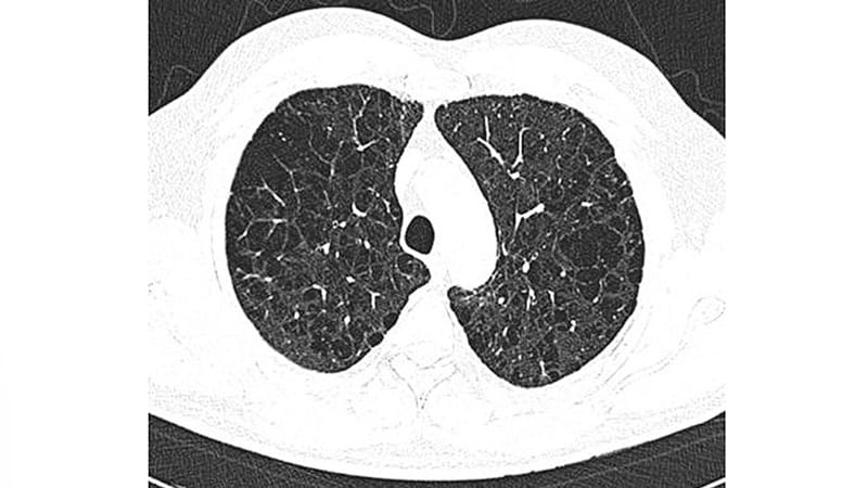 Defining COPD Phenotypes With Advanced Imaging