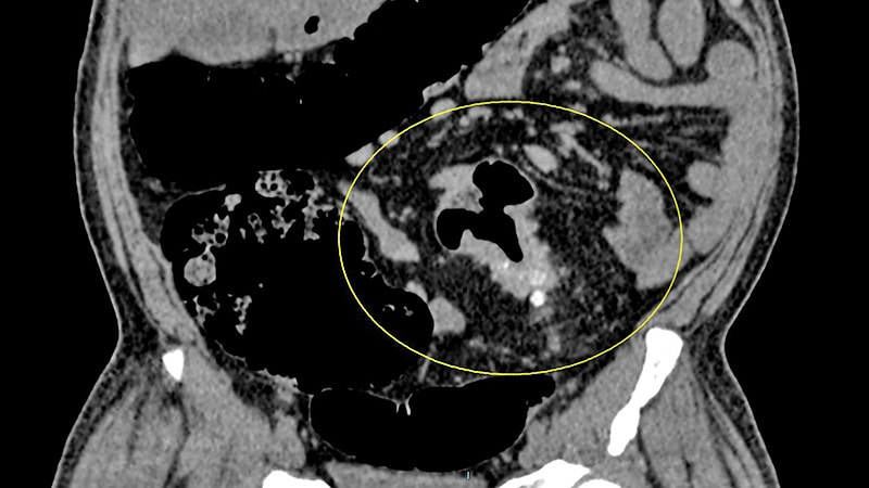 The Best Upfront Regimen for Unresectable CRC Liver Mets?