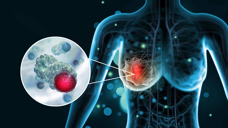 New High-Risk TNBC Subgroup Identified