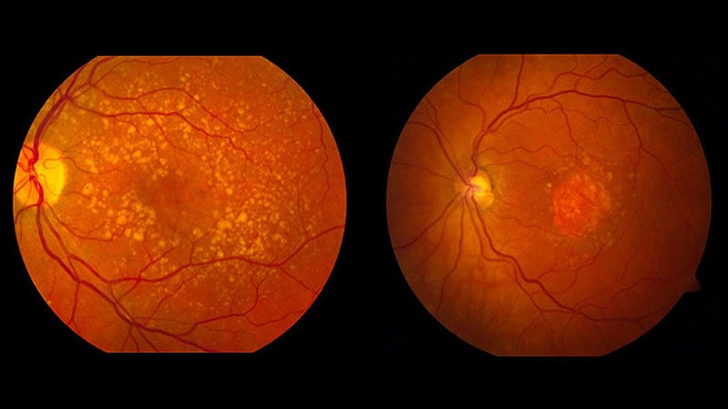 GLP-1 RAs Linked to Doubled Risk for Macular Degeneration