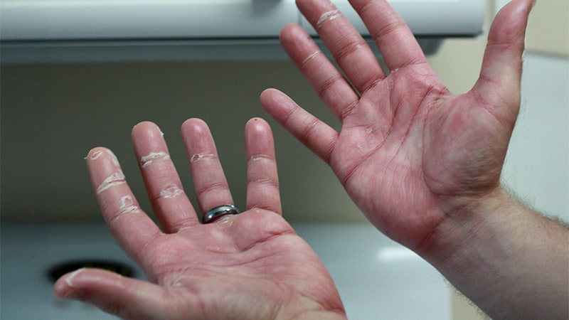 Toxische Hautirritationen: Neue Krebsmedikamente, neue Nebenwirkungen