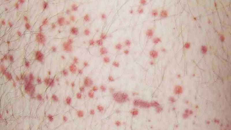 Europe Set to Approve New Immune Thrombocytopenia Therapy