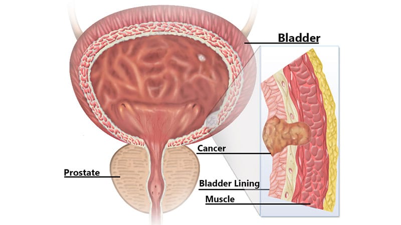 Adjuvant Radiation Boosts High-Risk Bladder Cancer Control