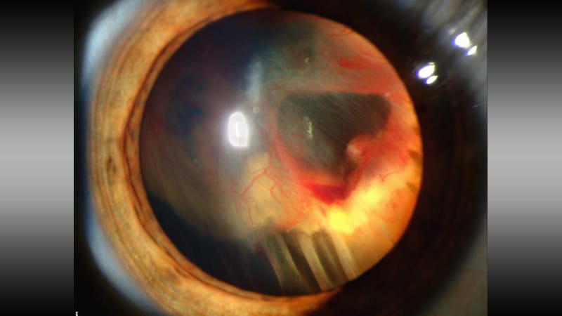 Does This ED Drug Harm the Retina?