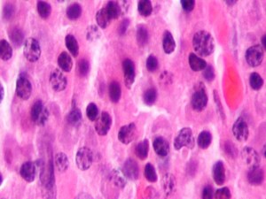 In Real World, Patients With Myeloma Have Worse Outcomes