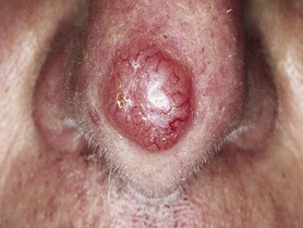 photo of Basal Cell carcinoma