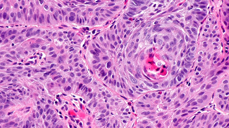 Chemoimmunotherapy vs Standard Care in ESCC: Is One Better?