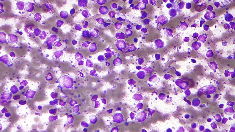 Can New Biomarker Help Identify High-Risk DLBCL Patients?