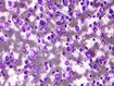 photo of Diffuse large B-Cell Lymphoma