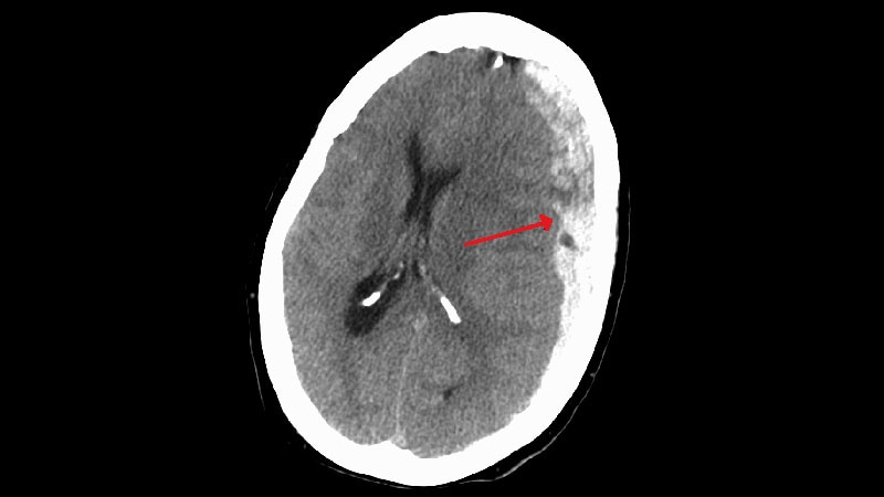 Subdural Hematoma Embolization Success Cuts Surgery Need