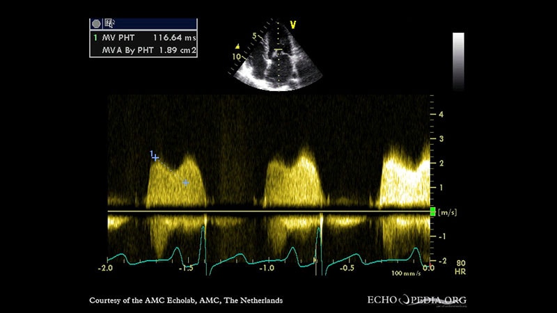 Lithotripsy for Mitral Valve Stenosis: What's the Promise?