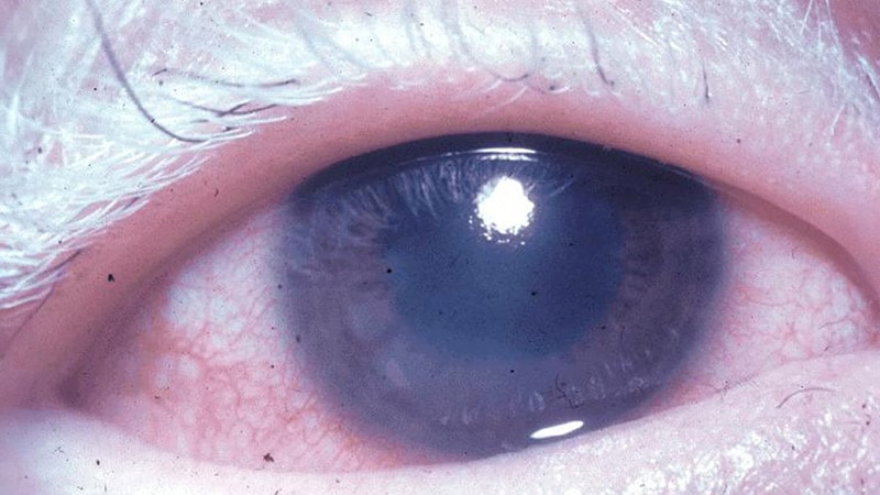 Filgotinib Cuts Therapy Failures in Uveitis