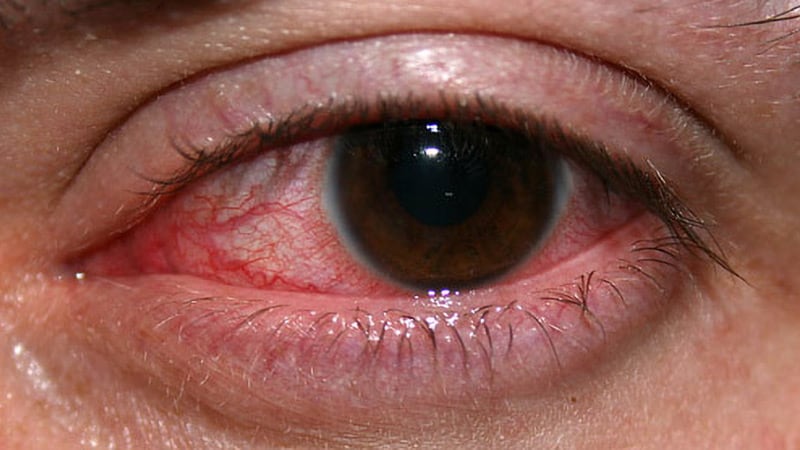 Hidradenitis Suppurativa Linked to Inflammatory Eye Disease