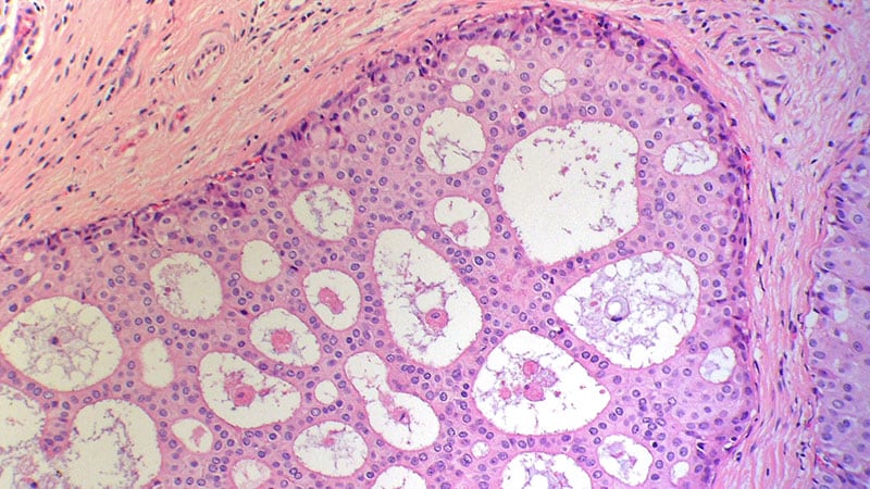 photo of  Breast cancer