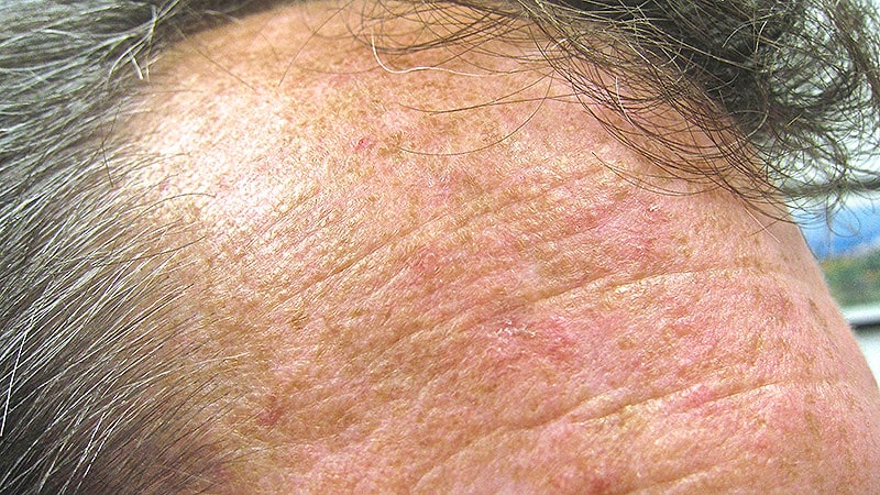 Transplant Recipients Face High Risk for Actinic Keratosis thumbnail