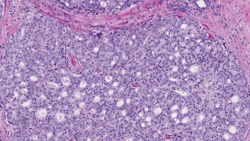 Inadequate Grading of Intraductal Carcinoma of the Prostate