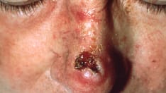 Imaging Aids High-Risk Cutaneous SCC Management