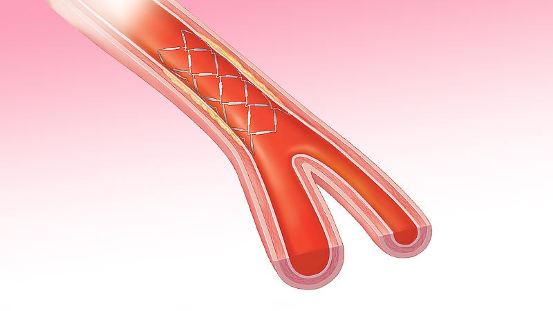 Diabetes Status May Not Affect Outcomes of Preventive PCI