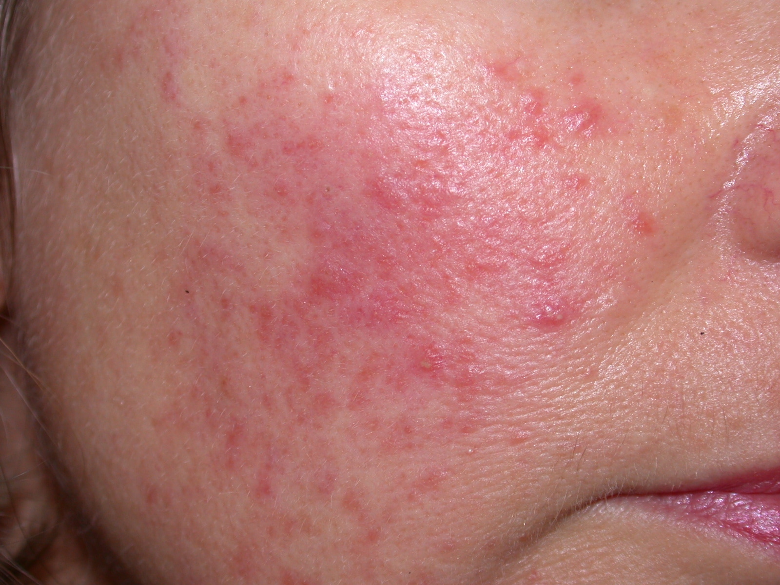 skin-rash-on-one-side-of-face-allergy-trigger