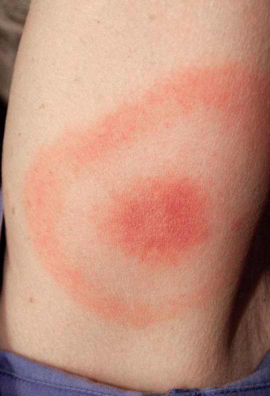 wasp sting infection signs