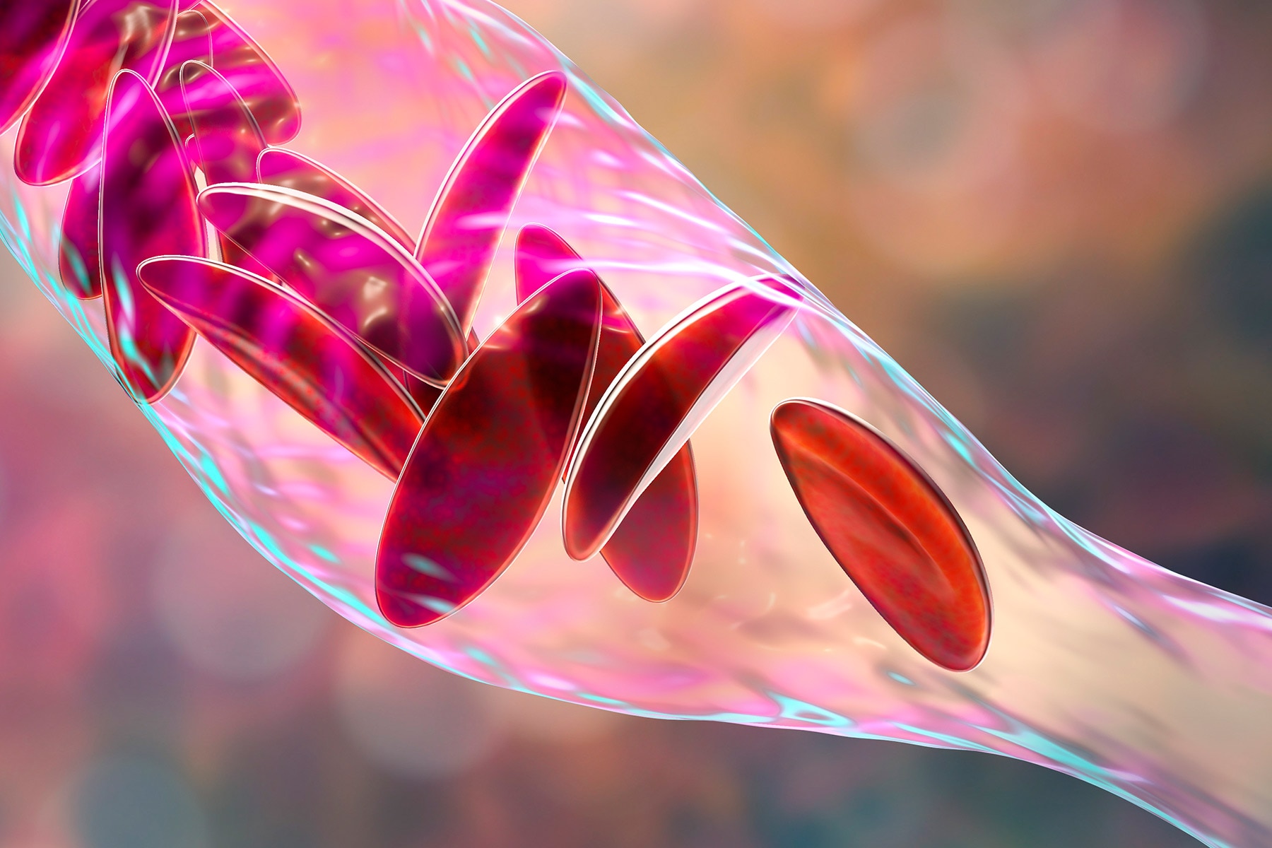 'Shocking' Delays in Pain Relief for Sickle Cell Patients
