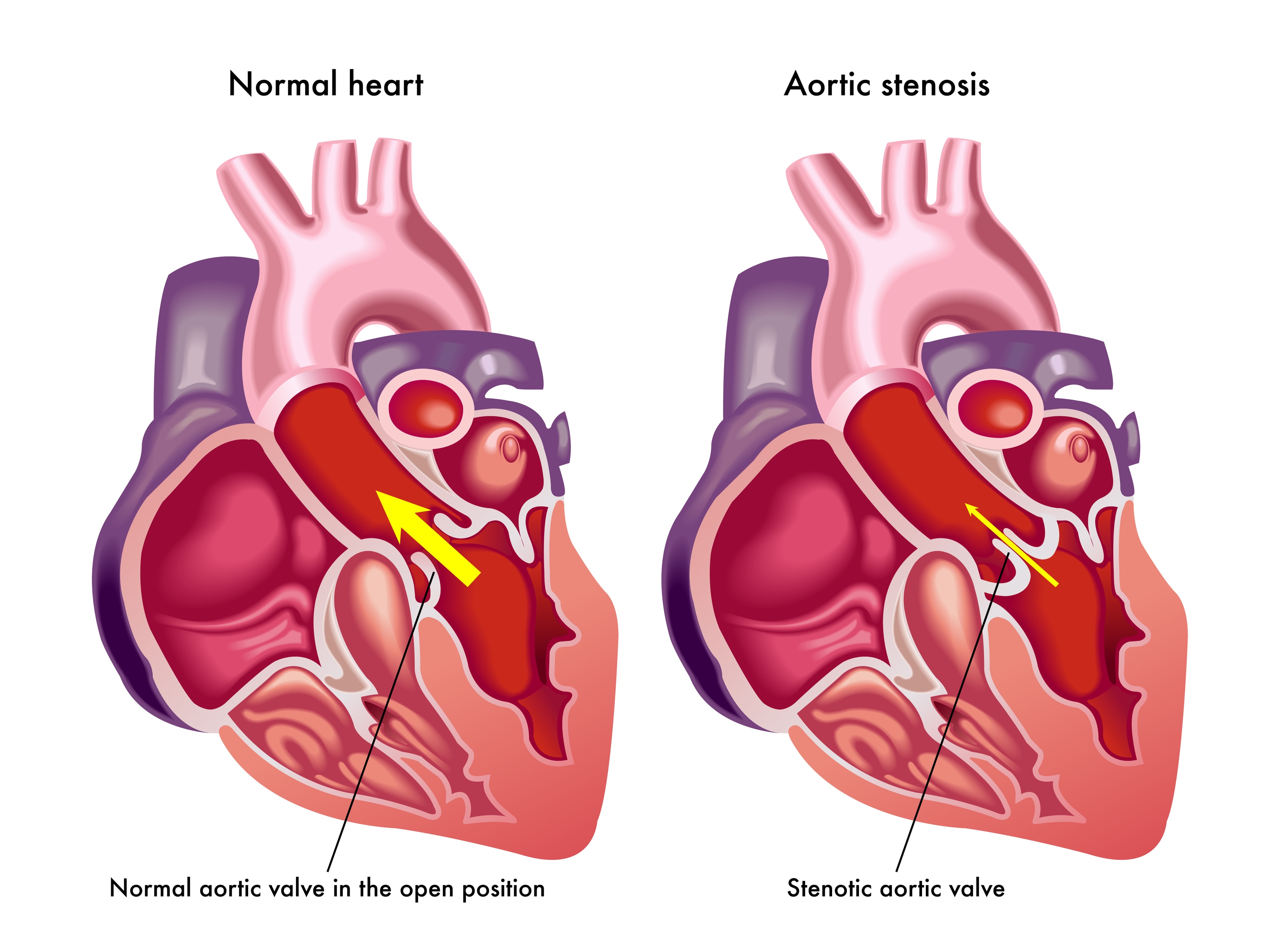 How Long Can An Elderly Person Live With Severe Aortic Stenosis