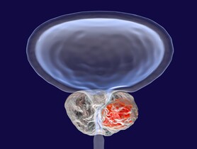 DT_180329_prostate_cancer_102338007.jpg