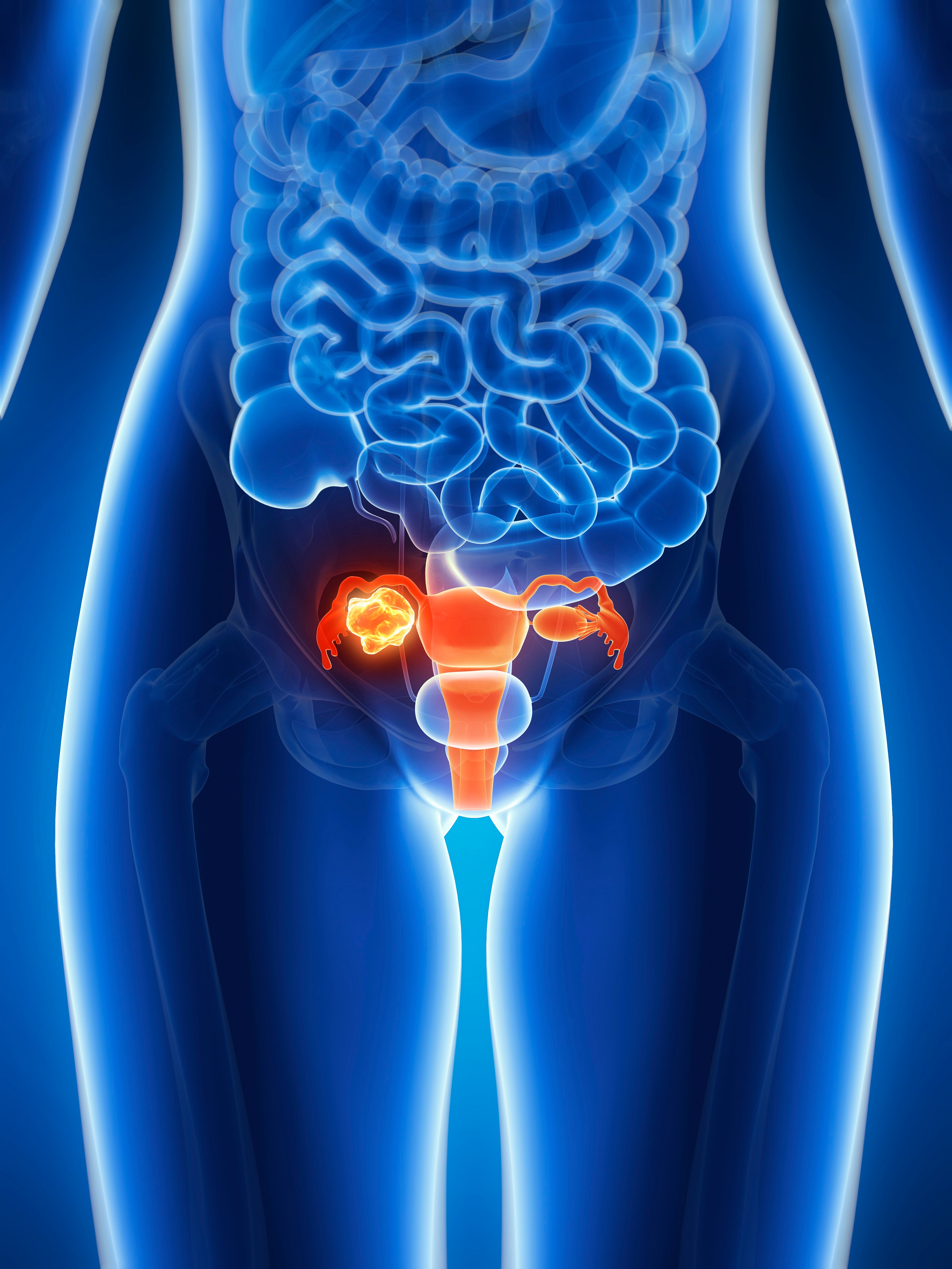 majority-of-women-polled-unable-to-id-ovarian-cancer-symptoms